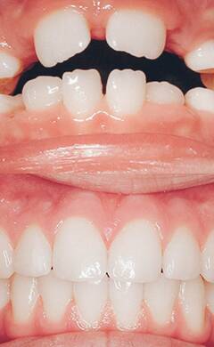 Zähne vorstehende Zähne: